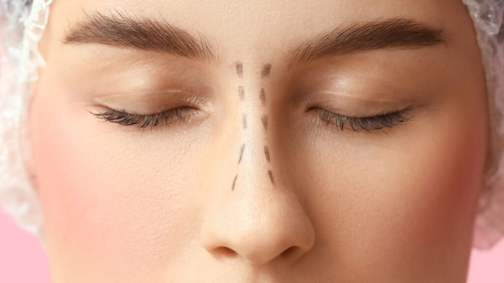 rhinoplastie sans chirurgie